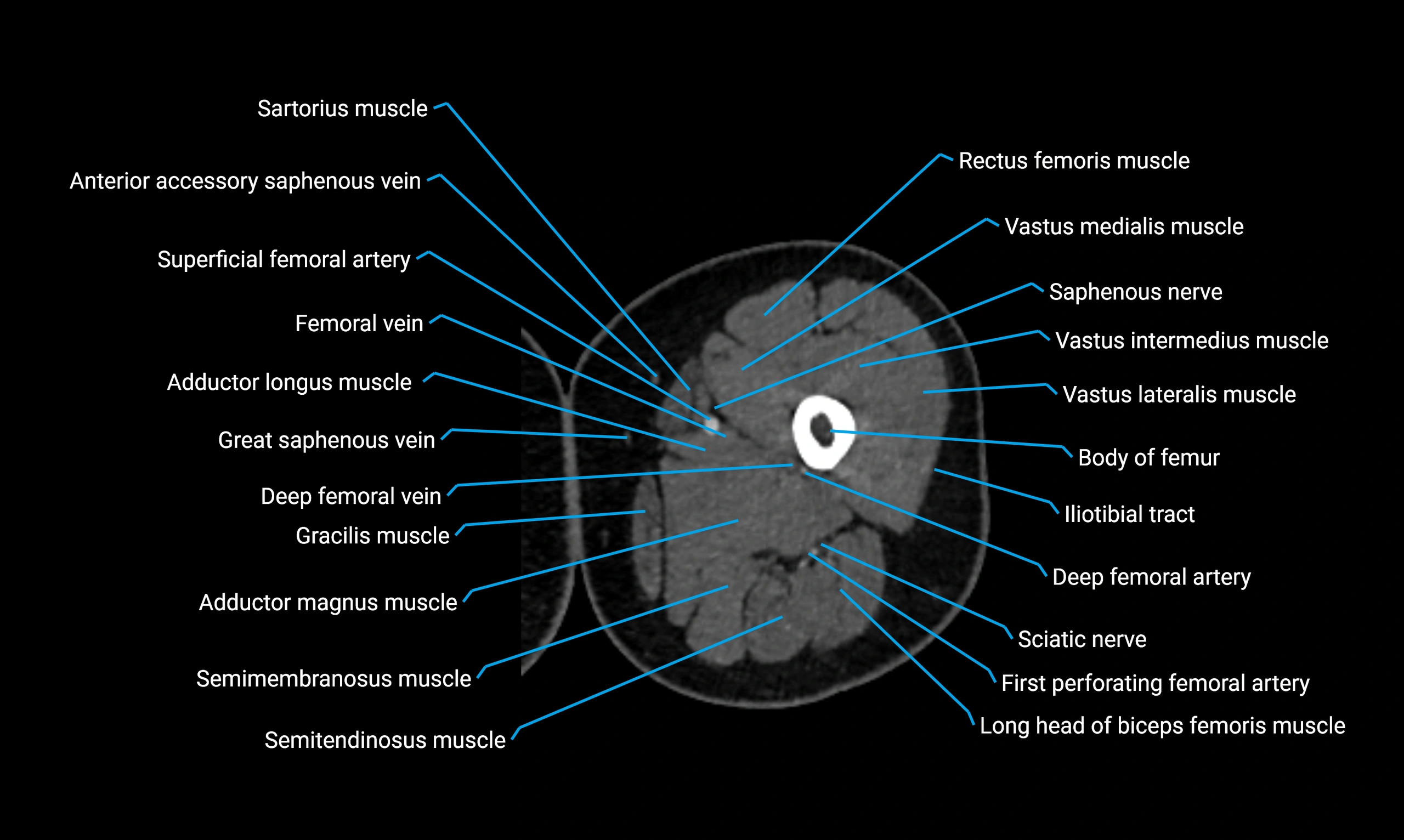 CT lower limb axial cross sectional anatomy labelled image 45 (2).webp